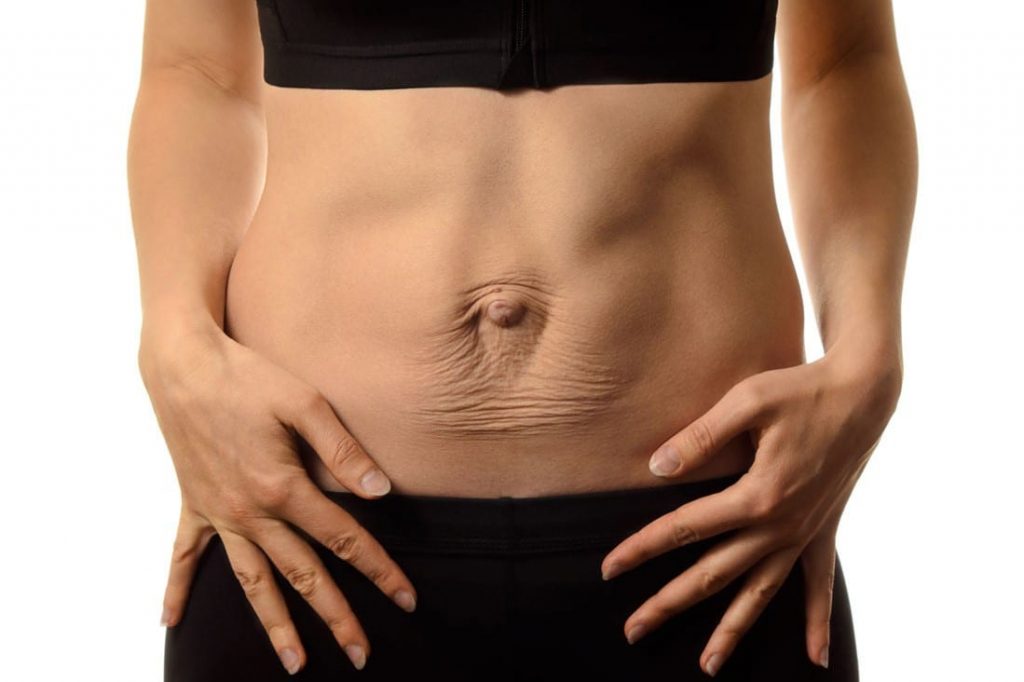 Programme diastasis